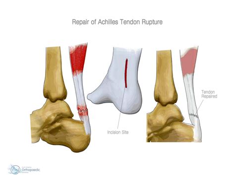 Tendon of Achilles (TA) Repair: “This is How I Do It” .